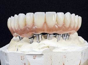 dental implant procedure chatswood