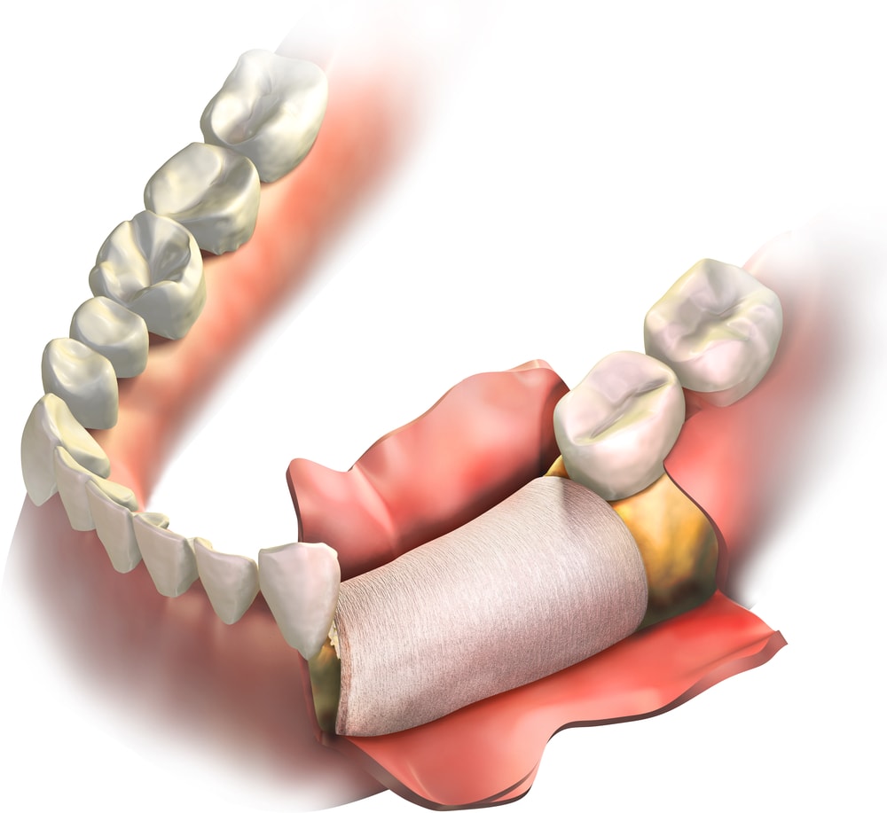 an illustration of a dental bone grafting
